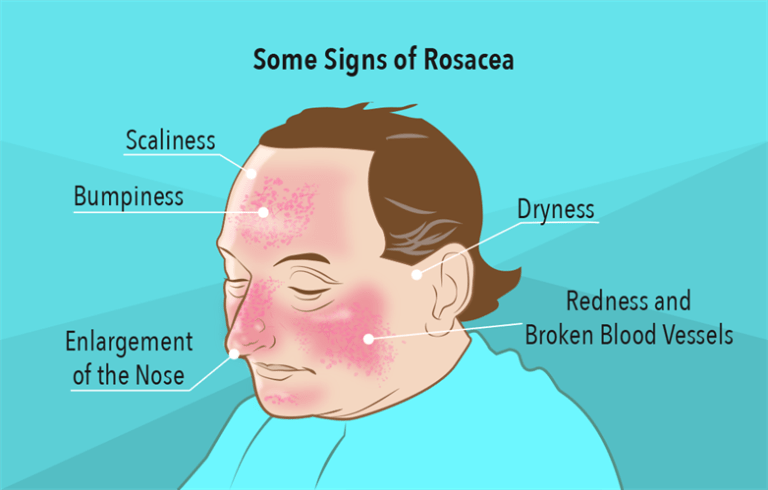 flushing-causes-symptoms-and-treatment