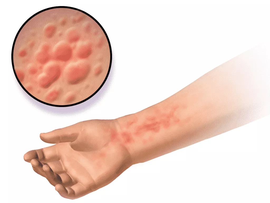 Hives Causes, Symptoms, Diagnosis, Treatment, and Prevention