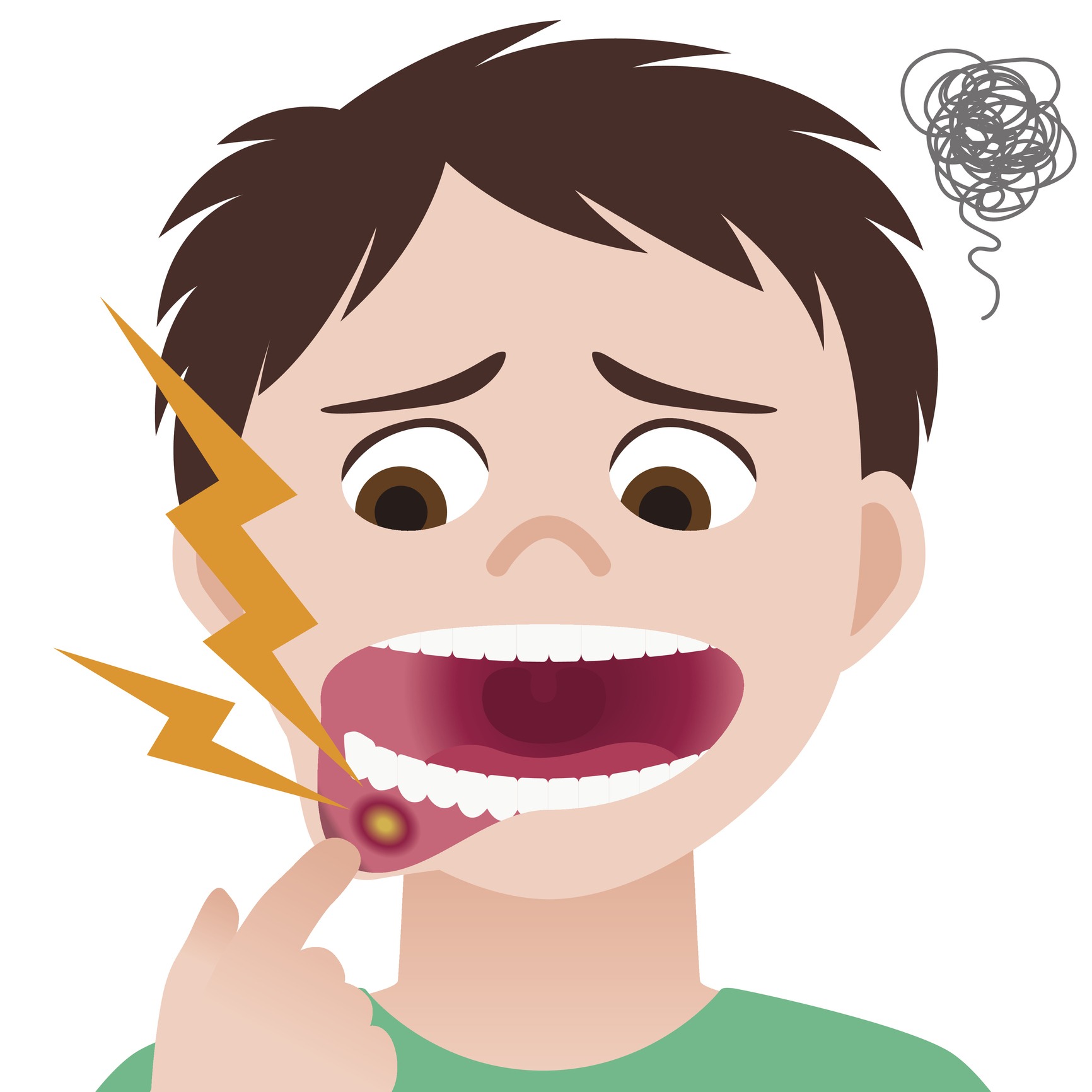 canker-sores-mouth-ulcers-can-be-irritating-in-your-mouth