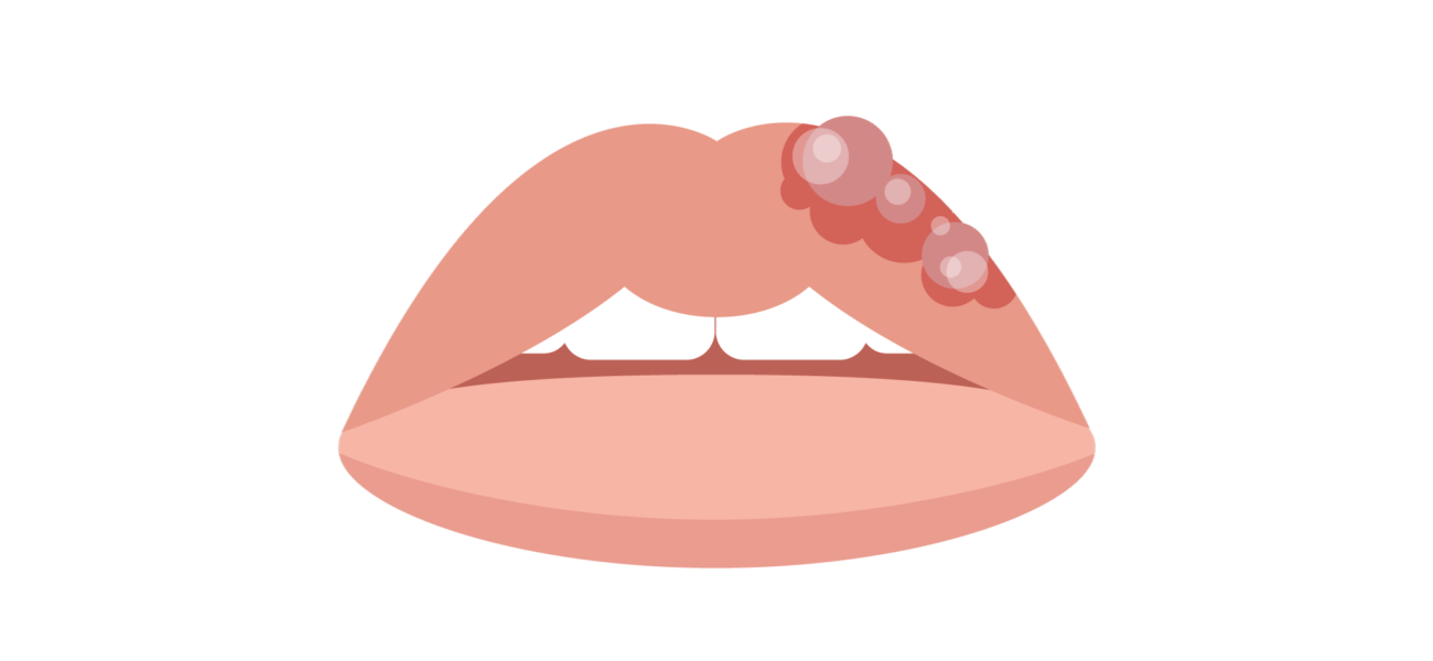 Swelling of Lips: Causes, Symptoms, and Treatment