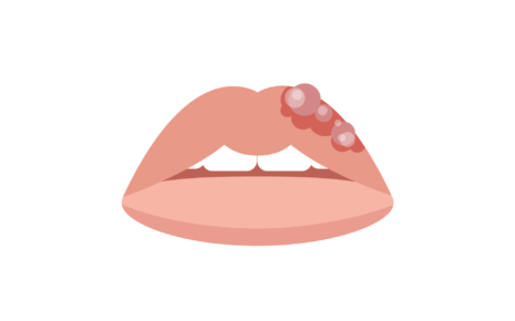 Swelling of Lips: Causes, Symptoms, and Treatment