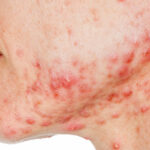 What is Acne Vulgaris?