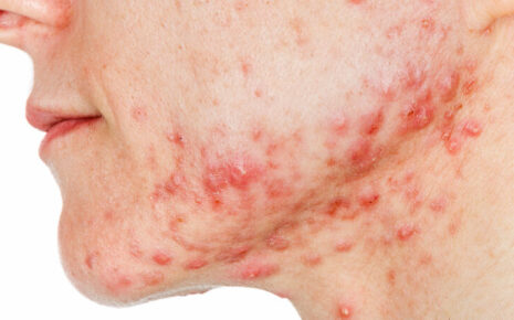 What is Acne Vulgaris?