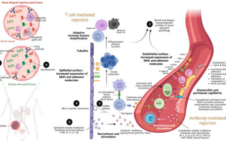 What is Acute Renal Graft Rejection?