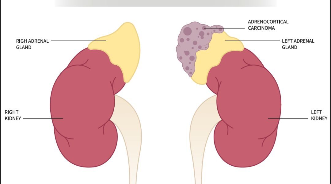 What is Adrenocortical Carcinoma?