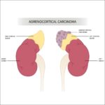 What is Adrenocortical Carcinoma?