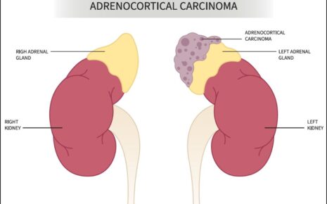 What is Adrenocortical Carcinoma?