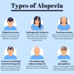 Alopecia Areata