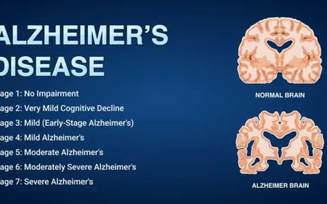 What is Alzheimer?