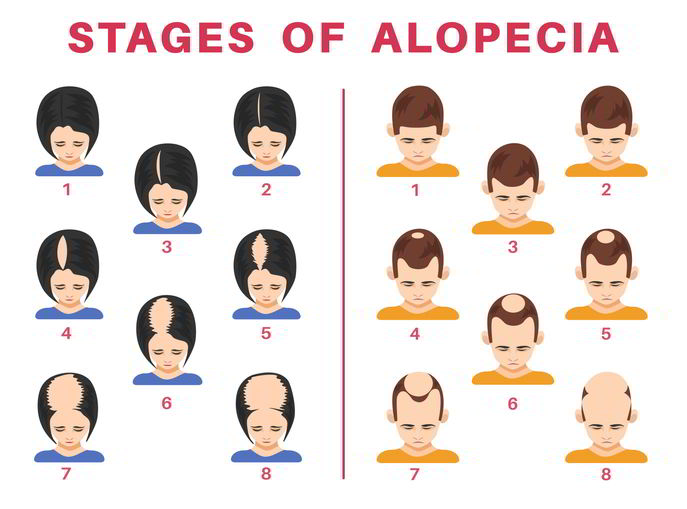 What is Androgenetic Alopecia?