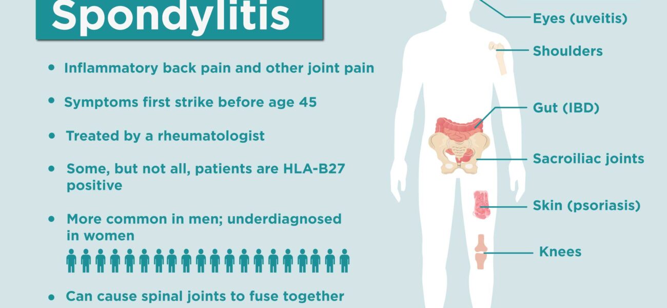 What is Ankylosing Spondylitis?