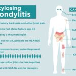What is Ankylosing Spondylitis?