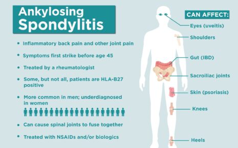 What is Ankylosing Spondylitis?