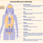 Anorexia