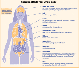 Anorexia
