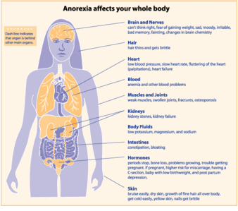 Anorexia