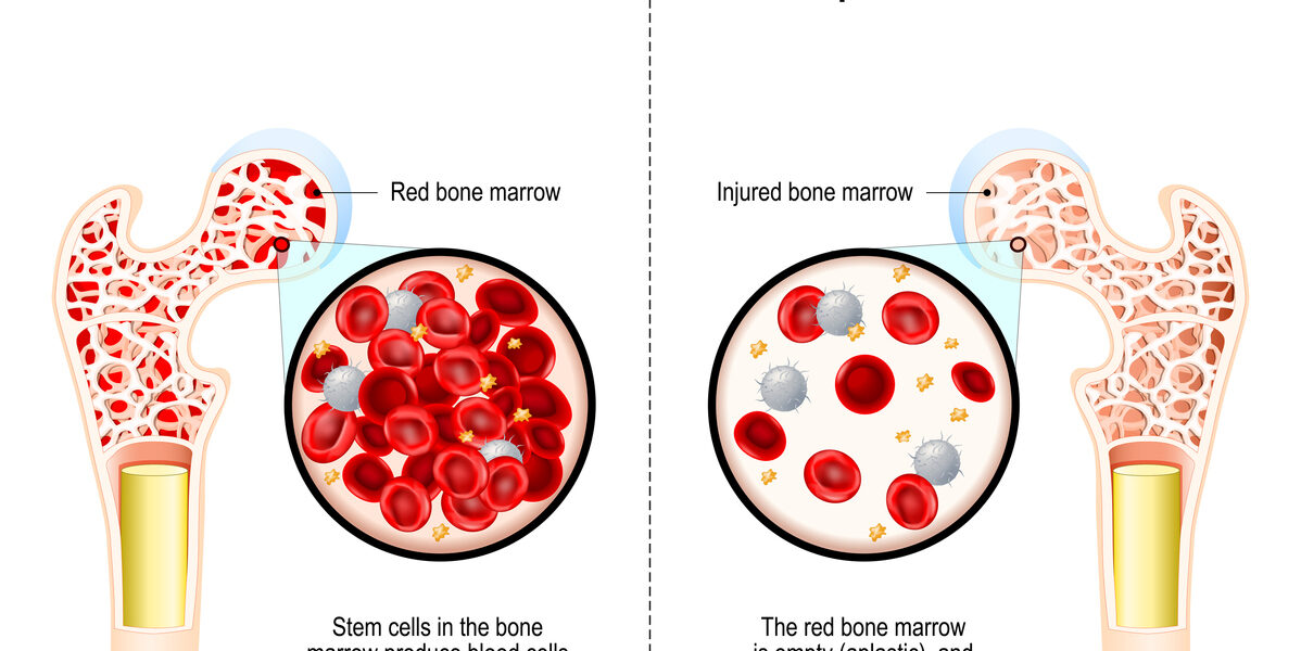 What is Aplastic Anemia?