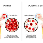 What is Aplastic Anemia?