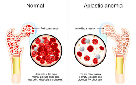 What is Aplastic Anemia?