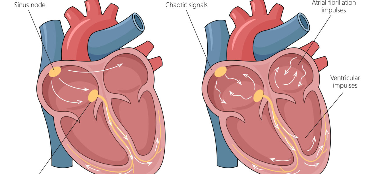 What is Arrhythmias?