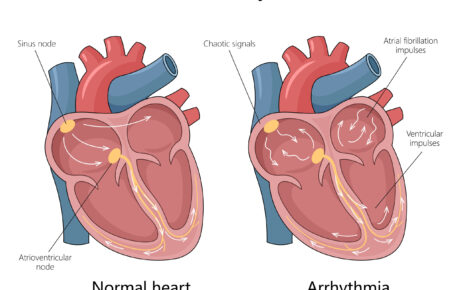What is Arrhythmias?