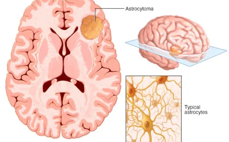 What is Astrocytoma?