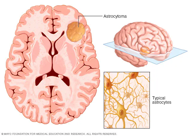 What is Astrocytoma?