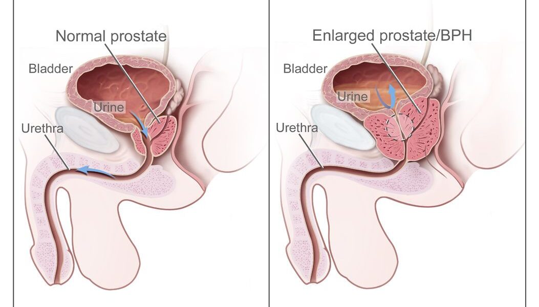 What is Benign Prostatic Hyperplasia?