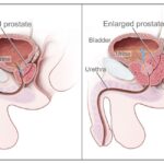 What is Benign Prostatic Hyperplasia?