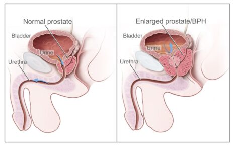 What is Benign Prostatic Hyperplasia?