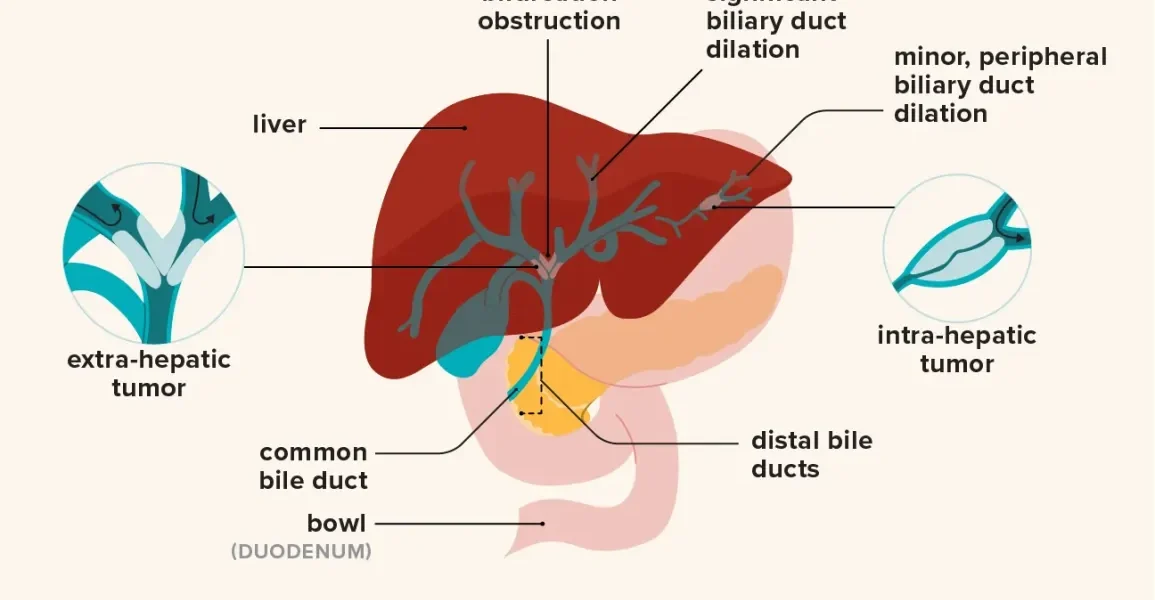 What is Bile Duct Cancer?