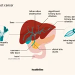 What is Bile Duct Cancer?