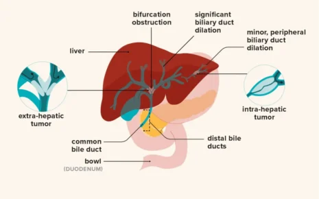 What is Bile Duct Cancer?