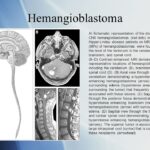 What is Central Nervous System Hemangioblastomas?