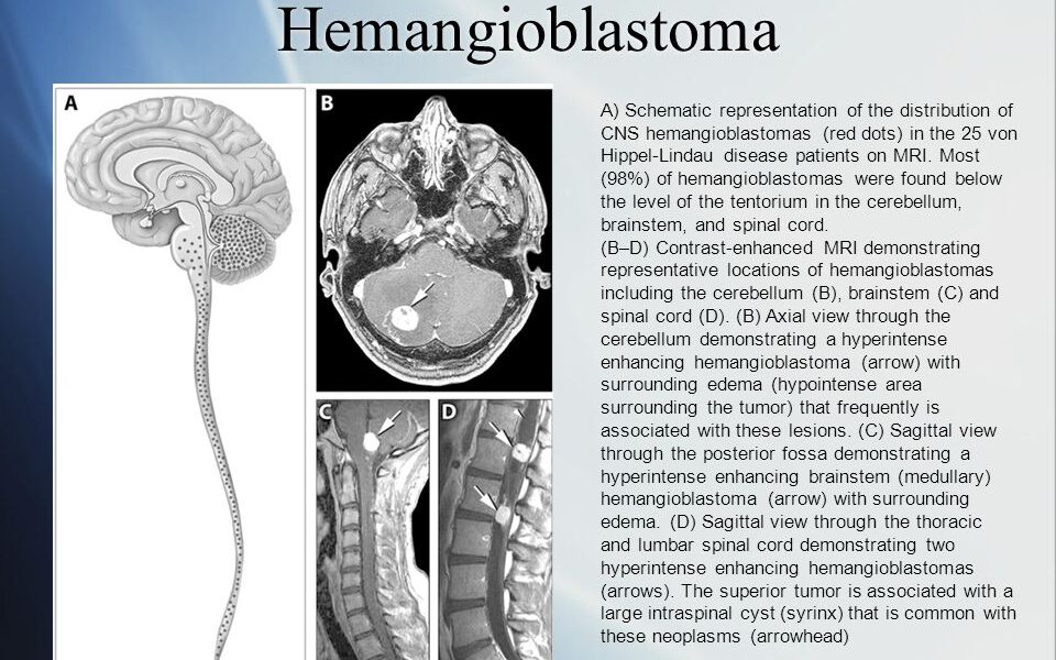 What is Central Nervous System Hemangioblastomas?