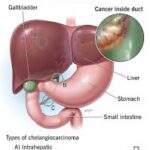 What is Cholangiocarcinoma?