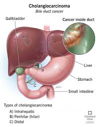 What is Cholangiocarcinoma?