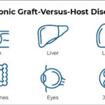 Chronic Graft-Versus-Host Disease (cGVHD)