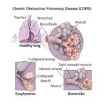 Chronic Obstructive Pulmonary Disease