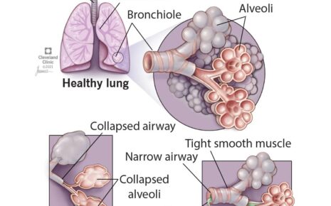 Chronic Obstructive Pulmonary Disease