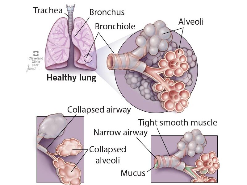 Chronic Obstructive Pulmonary Disease
