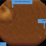 CMV Retinitis