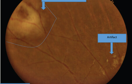 CMV Retinitis