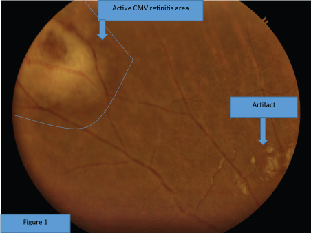 CMV Retinitis