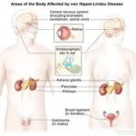 Von Hippel-Lindau Disease