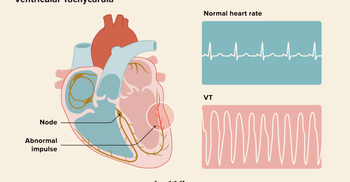What is Ventricular Tachycardia