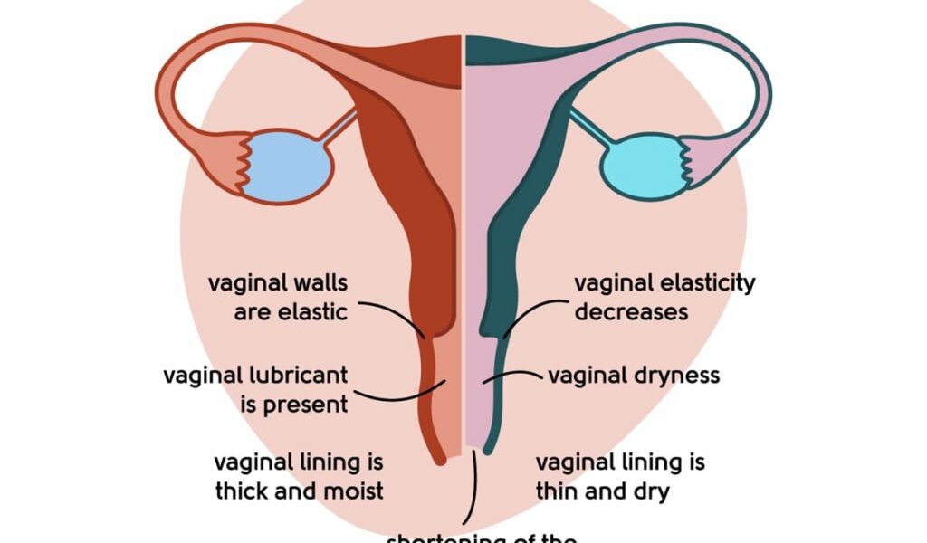 What is Vaginal Dryness