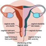 What is Vaginal Dryness