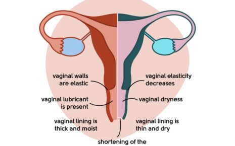 What is Vaginal Dryness