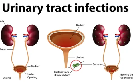 What is Urinary Tract Infections (UTIs)